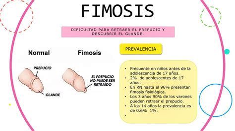 fimosis foto|Galería de Imágenes y Fotos de la Circuncisión